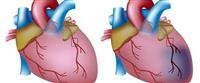 heart attack.,