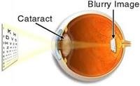 What causes blurred vision