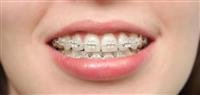 Common Braces Cases