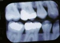 Dental, Implants