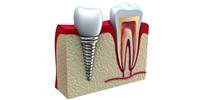 Dental implants using stem cells