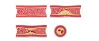 Atherosclerosis