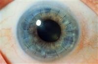 Corneal Transplantation