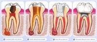A root canal?