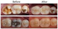 Dental Crowns (Dental Caps)