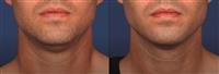 The causes of the double chin and how to treat it