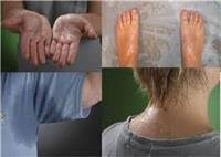 Hyperhidrosis | Treatment