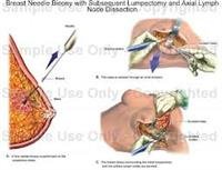 Lumpectomy: What to Expect