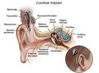 How does a cochlear implant work?