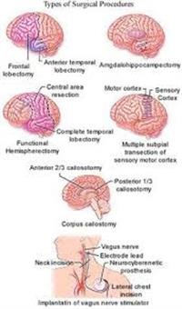 Types of Epilepsy Brain Surgery