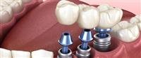 Dental implant method: the most important ...