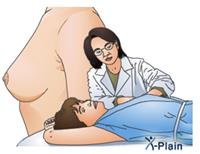 استِئصالُ الثَّدي