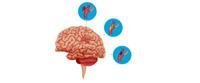 Brain aneurysm.