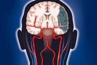 Tips for preventing strokes