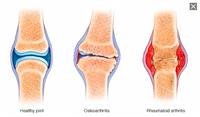 Arthritis