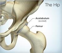 Preparing for Hip Replacement Surgery