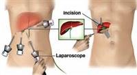 Gallbladder Removal