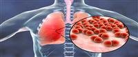 Pneumonia: the most important information,,,,,
