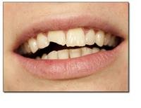 Tooth Cavities