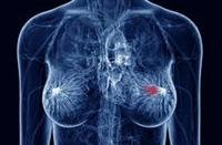 Early Stage Breast Cancer Not a Death Sentence