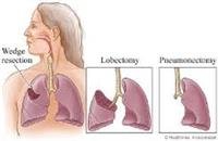 Lung Surgery for Lung Cancer