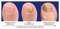 Treatments for Toenail Fungus