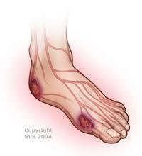 VascularDiseases and Pain