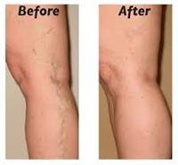 Varicose Veins - Treatment Overview