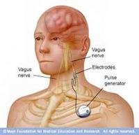 Nerve Stimulation for Epilepsy