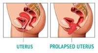 Pelvic Organ Prolapse