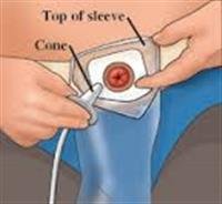 Colostomy Irrigation