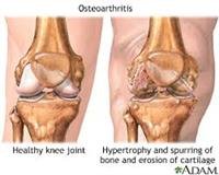 Surgery for Osteoarthritis Joint Pain