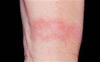 Dermatitis