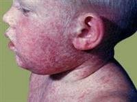 Rubella