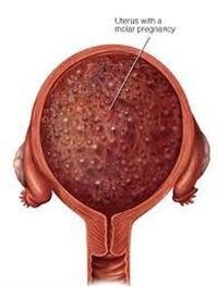 molar pregnancy...,