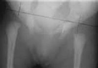 Screen All Newborns for Hip Dysplasia, Study Urges
