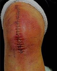 prevent DVT after joint surgery