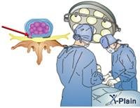 Kidney Stones - Treatment Overview
