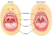 Sore Throat and Other Throat Problems