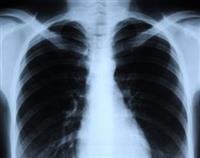 What is an X-ray?