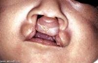 Cleft Lip