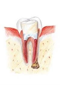 Toothache Treatment