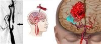 Don''t brush off signs of a "brain attack"