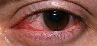 التهاب بكتيري بالقرنية
