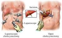 Laparoscopic Surgery for Digestive Problems