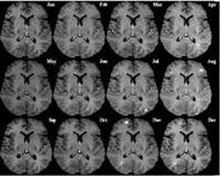 Diagnosing Multiple Sclerosis With MRI