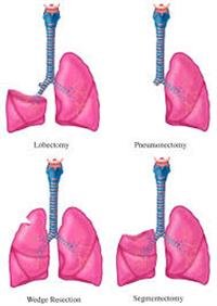 A Patient's Guide to Lung Surgery