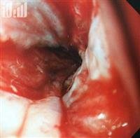 Saving a child''s esophagus from obstruction at
