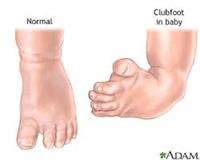 Clubfoot
