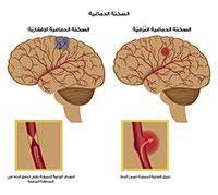 brain attack..